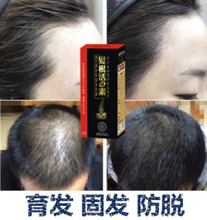 快速防脱止脱增发液生发黑发育发液脂溢性控油产后脱发头发增长液